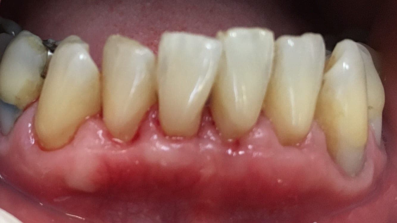 Gum Surgery – Case 1