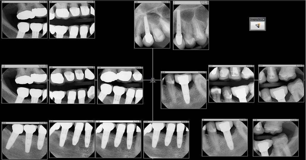 Healthy Implants For Over 10 Years