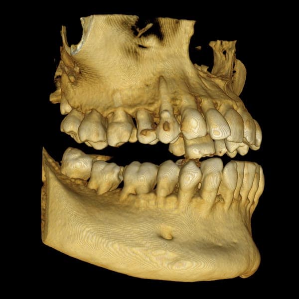 3D dental scan 12