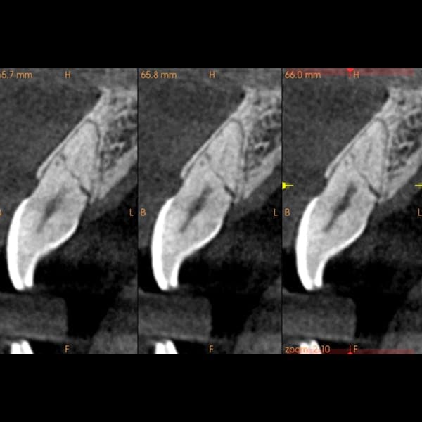 3D dental scan 11