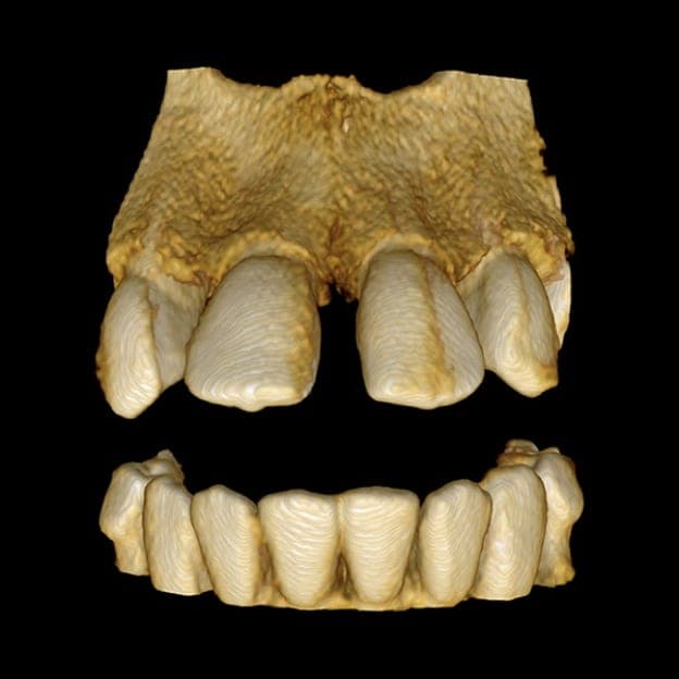 3D dental scan 4