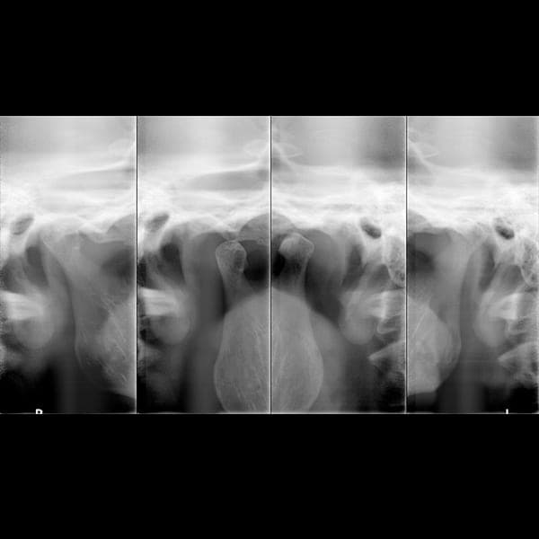 Panoramic dental X-ray 2