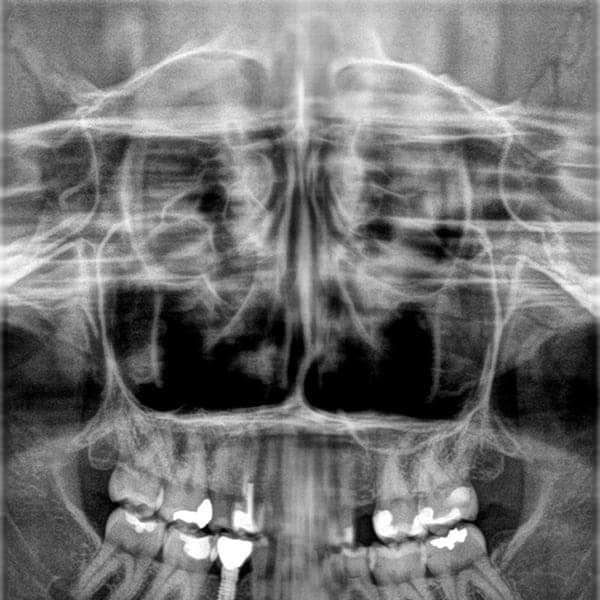 Panoramic dental X-ray 3