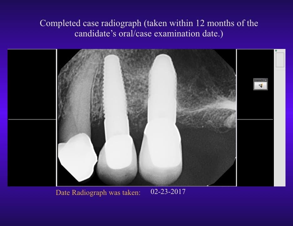 Patients Implants Over 4, 6 and 11 Years
