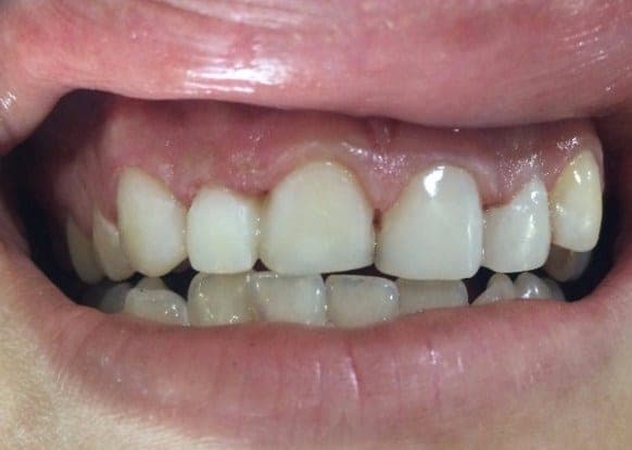 Case 6 — 16-year-old with severe gingivitis after — photo 1