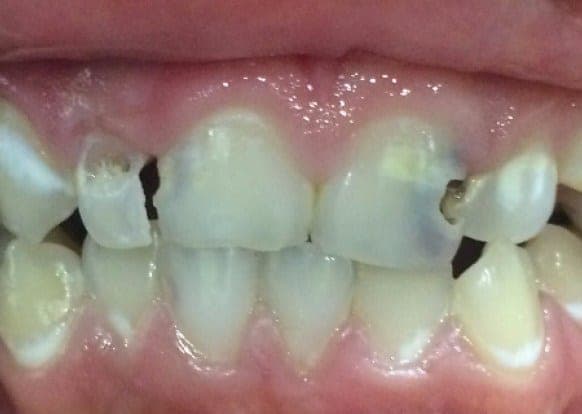Case 6 — 16-year-old with severe gingivitis before — photo 1