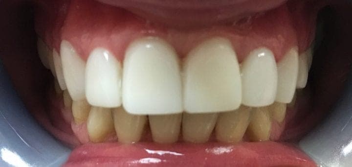 Close Teeth Gap Without Braces
