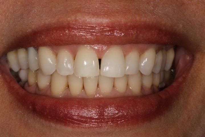 Closing Empty Spaces With Fixed Floss-able Teeth