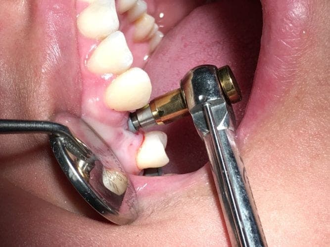 One Day Teeth Implant Steps