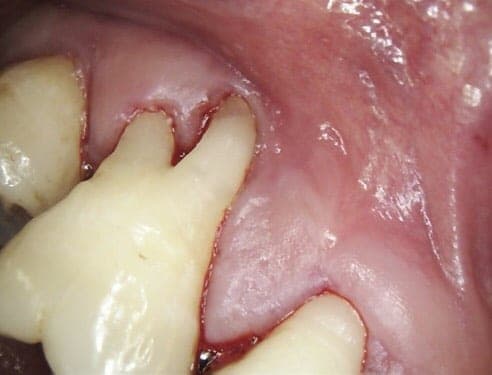 Gum Surgery : Covering the root and cosmetic work