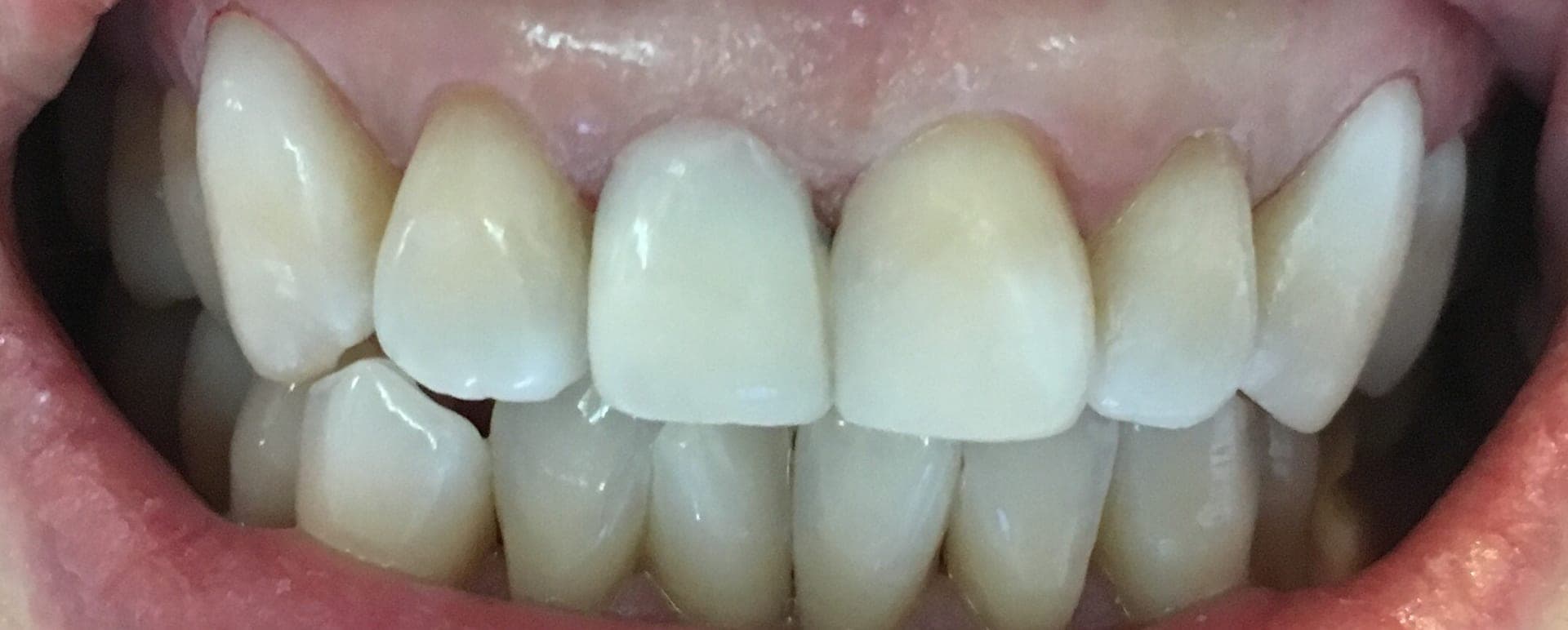 Teeth Whitening, Veneers & Fillings