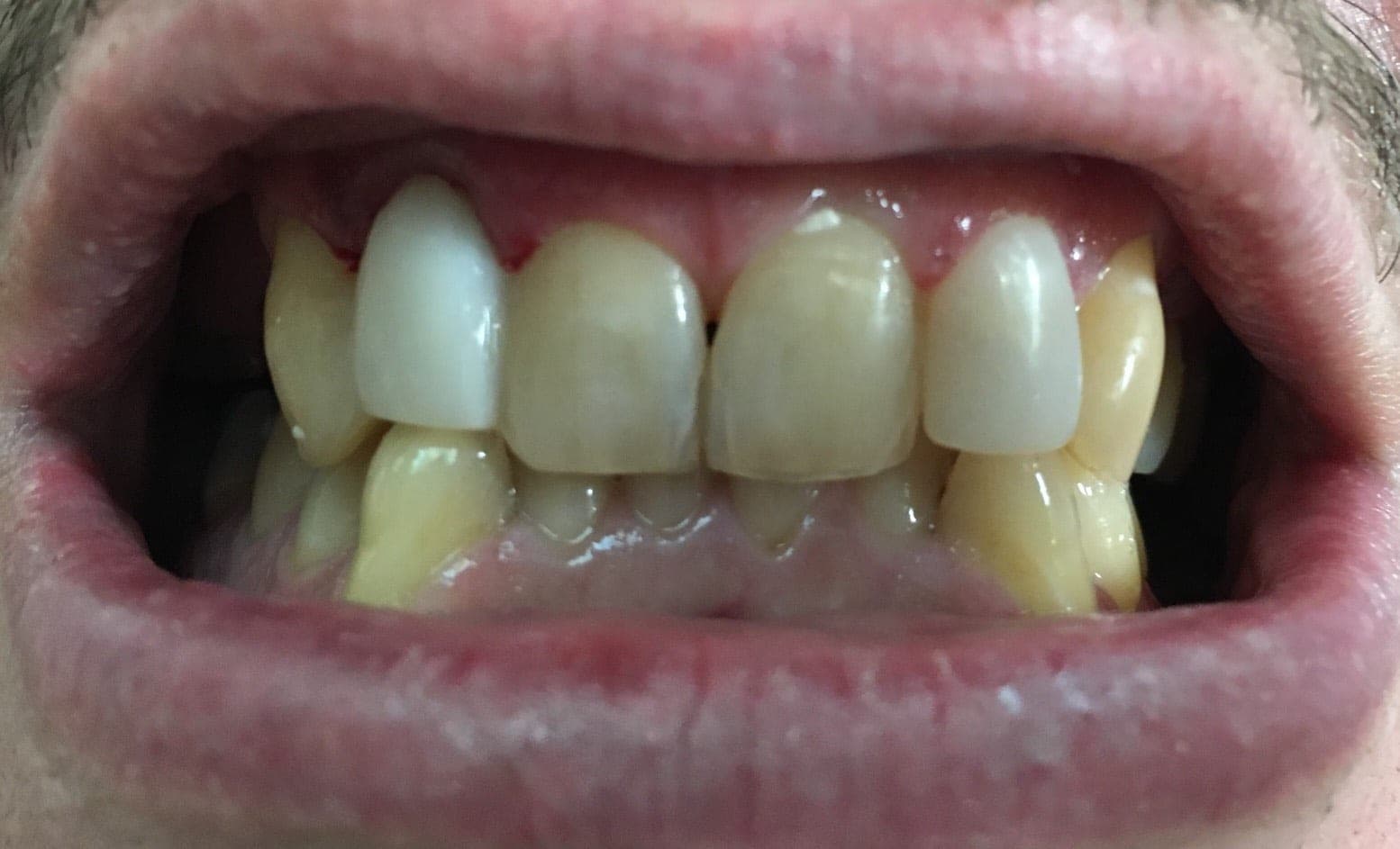 Infected Root Removal, Pontic Tooth & Resin Veneer in One Visit