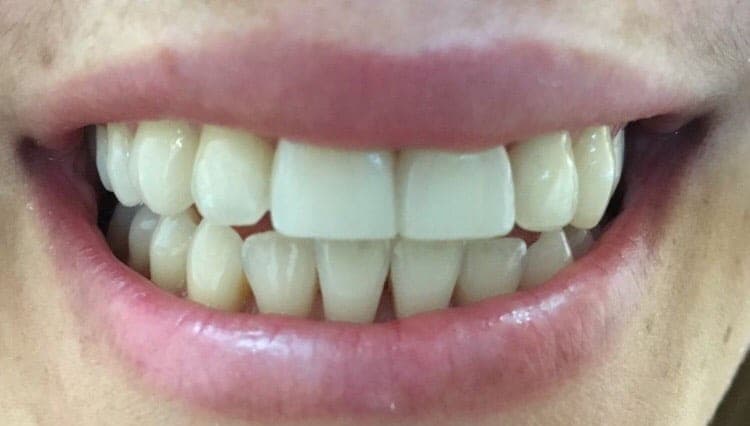 Composite Fillings In One Visit