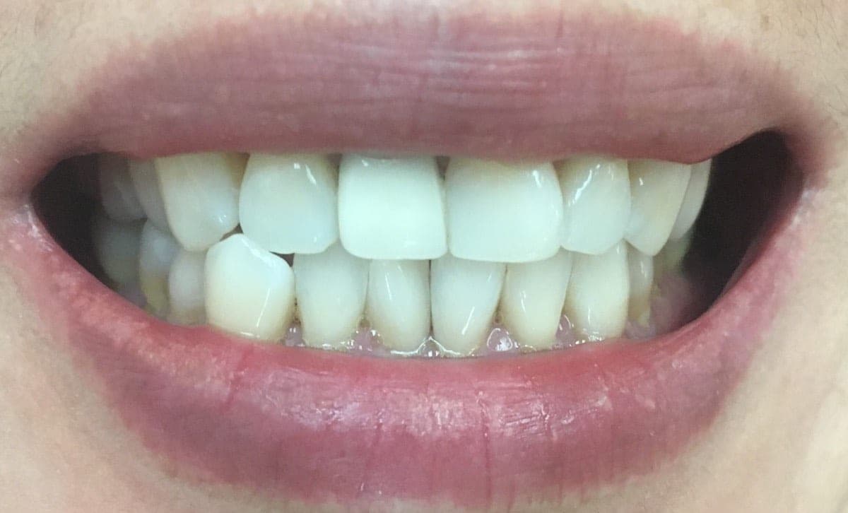 Composite Veneer On The Dark Crown