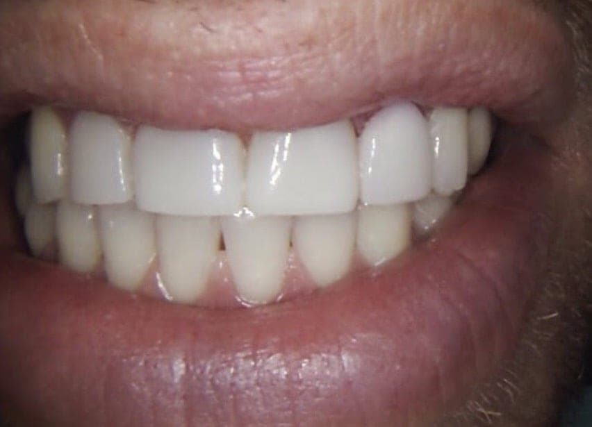 4 Composite Veneers in One Visit, 3 hours