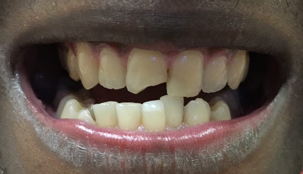 Two Composite Veneers In 2.5 Hours, Same Day