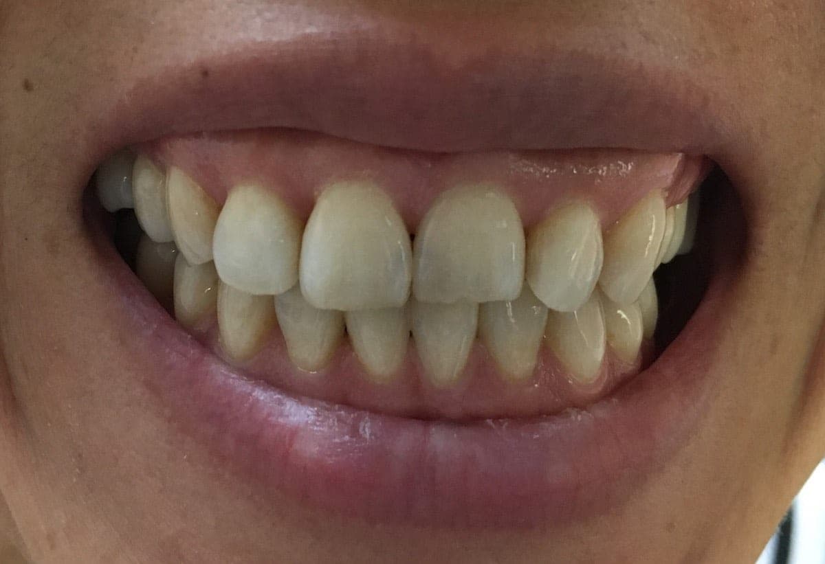 3 New One-Day Cases With Composite Veneers & Fillings