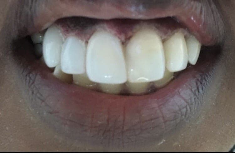 Longer, Straight Teeth in One Visit