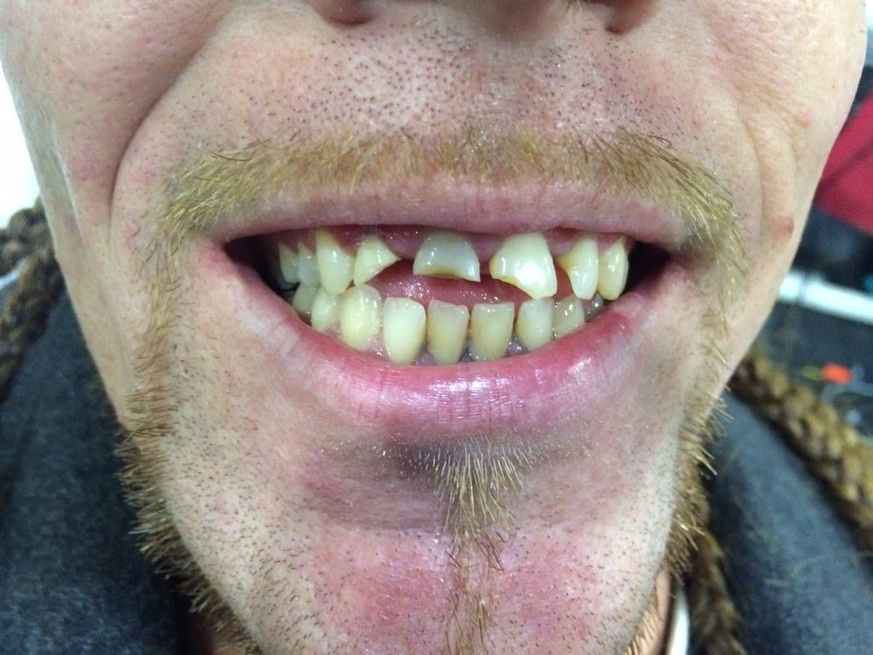 Jason Edward Tharpe — before treatment