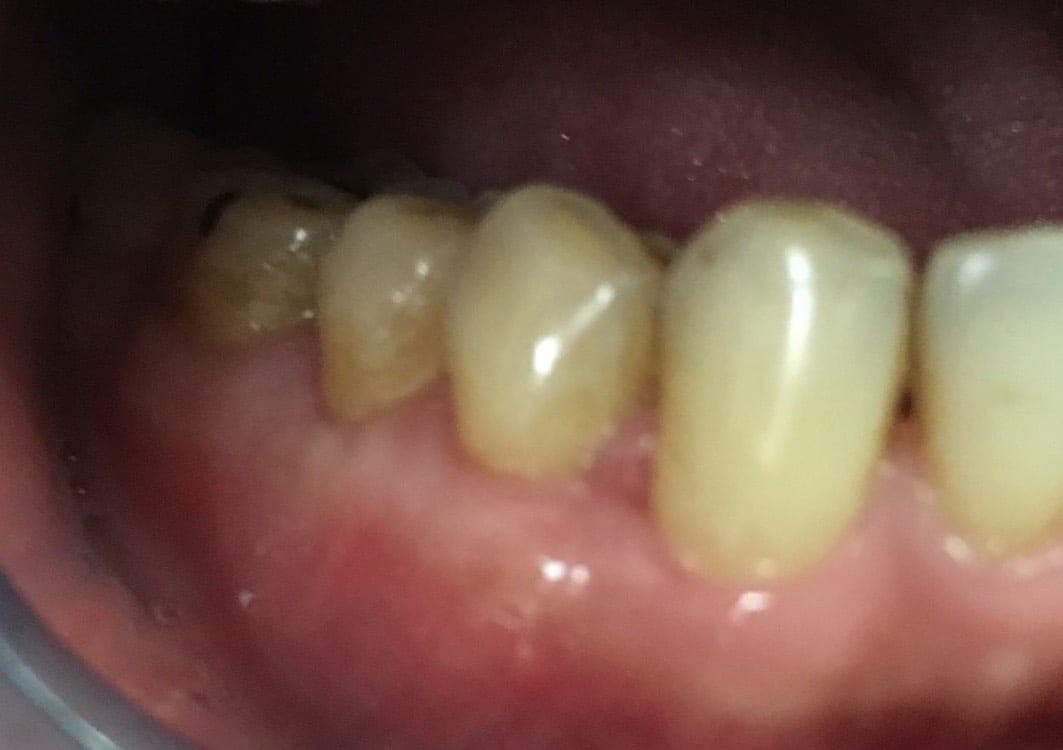 Gum Surgery – Case 2