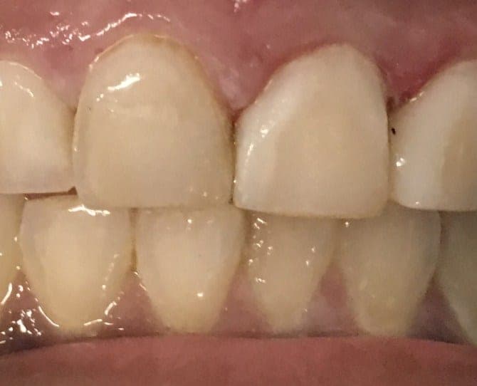 Patient 4 after