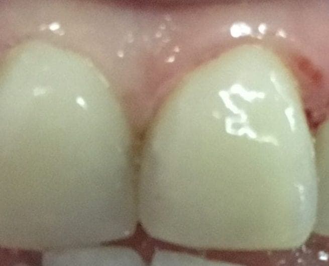 Patient 1 after