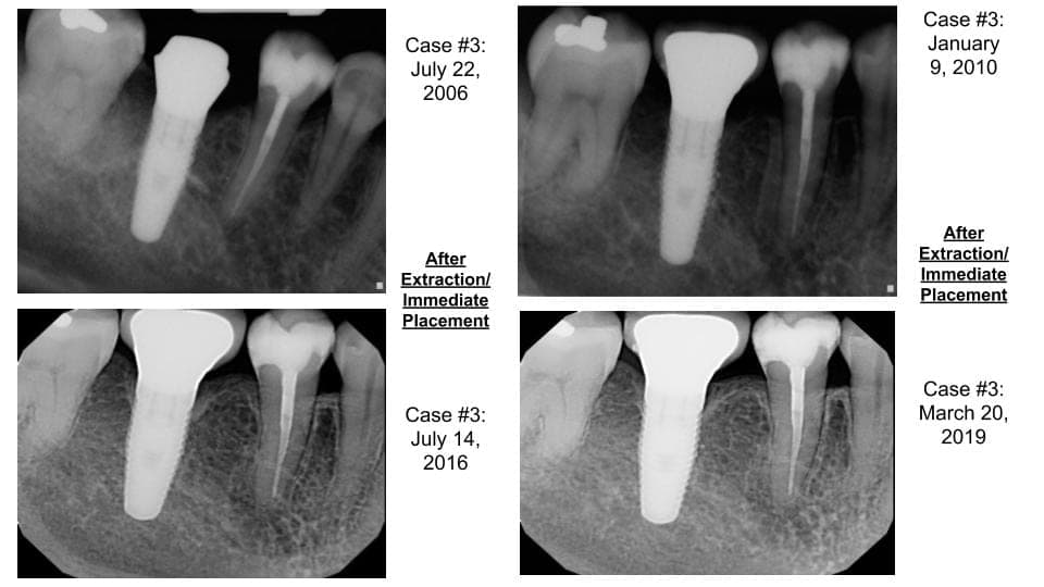 Healing one year after extraction and bone graft
