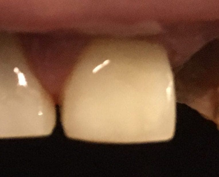 Patient 2 after