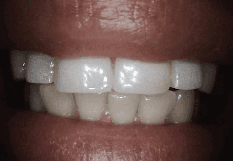 New Cases of Our Happy Patients