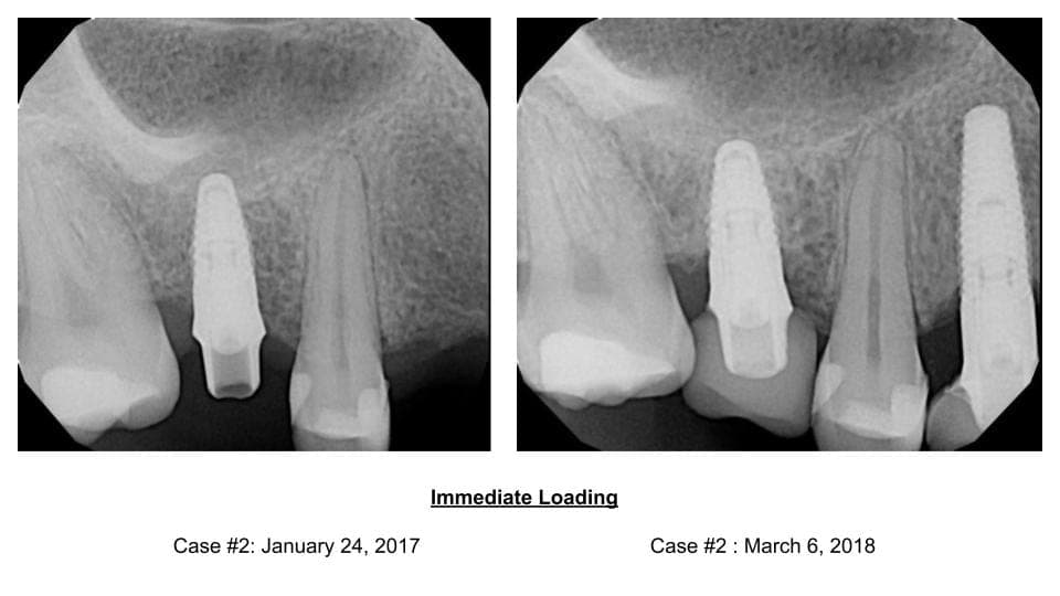 Immediate loading after implant placement