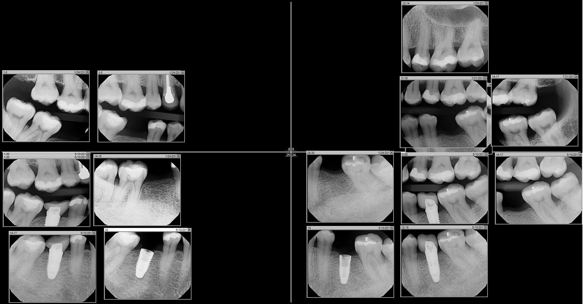 Immediate Loading-Chewing on Implant Crowns in One Visit – 2 Years Success