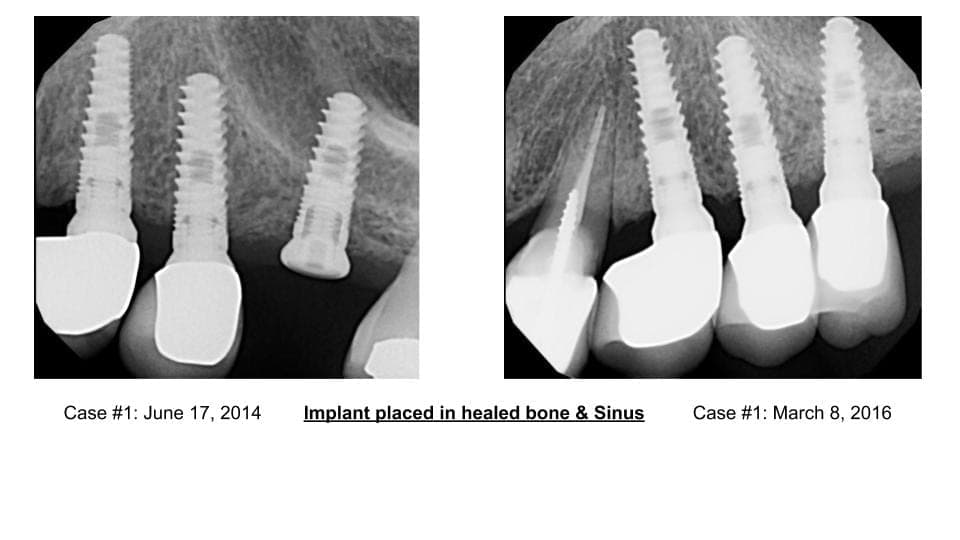 Implant placed