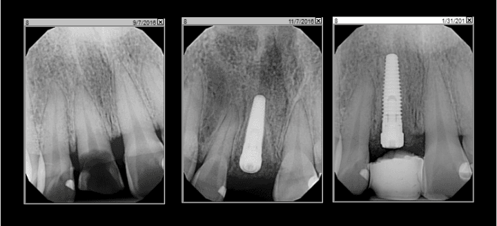 Severe Cavity & Broken Tooth in Half