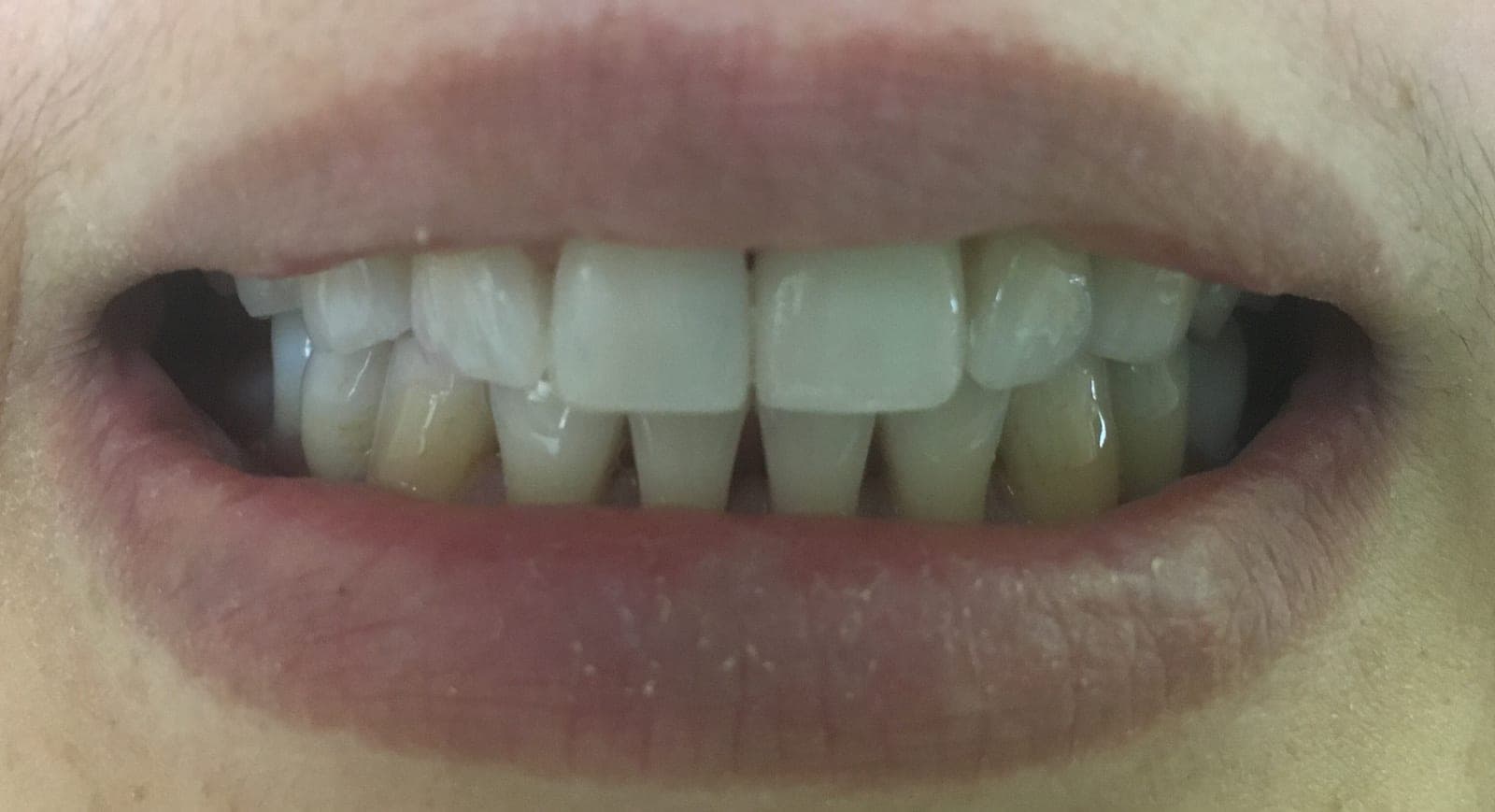 Only One-Visit CAD-CAM CEREC Porcelain Crowns