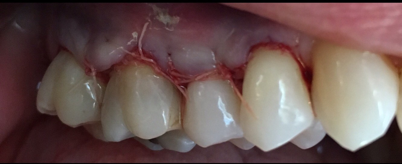 Right After Gum Graft