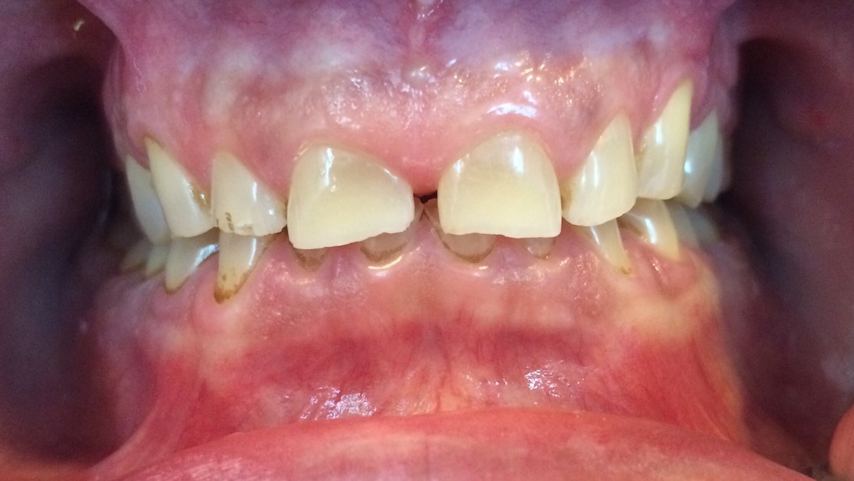 Patient's 8 Teeth