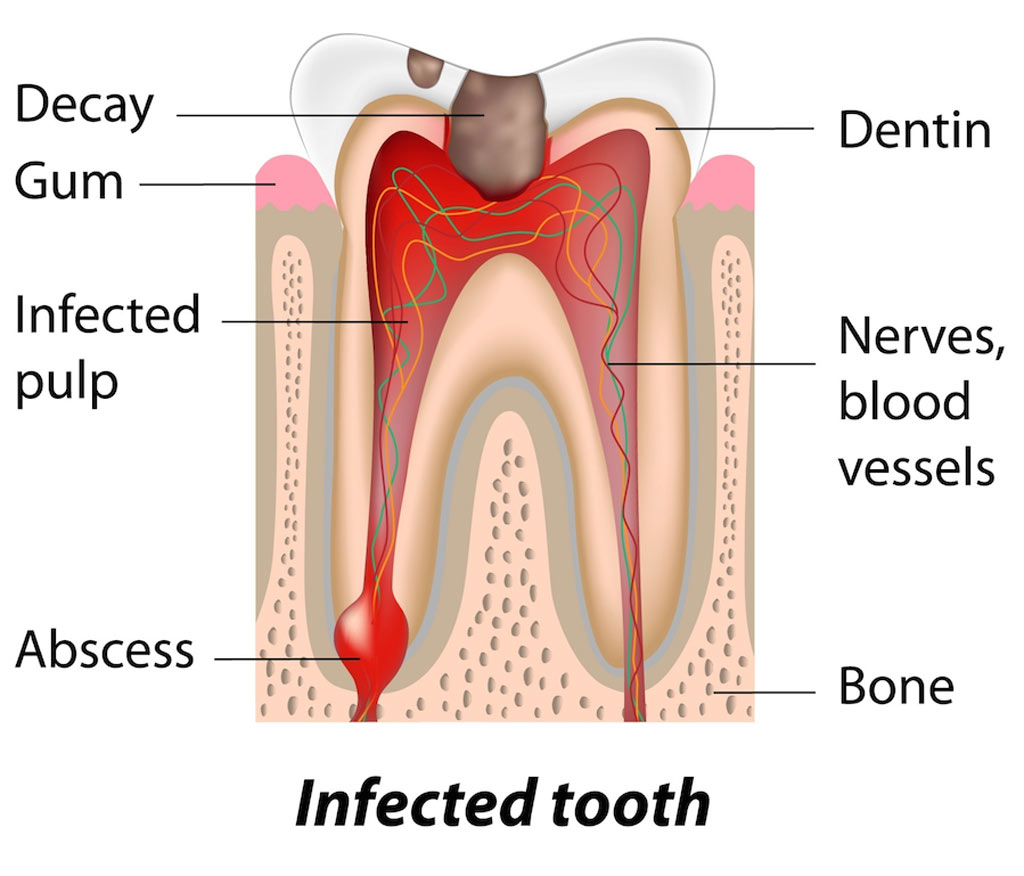 tooth decay