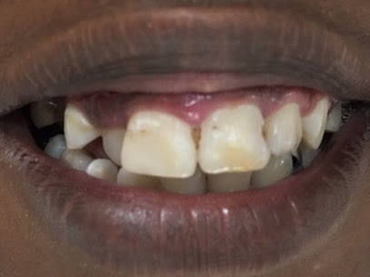 tooth decay