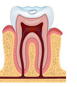 tooth decay
