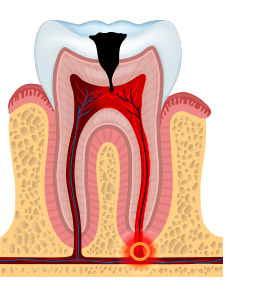 tooth decay