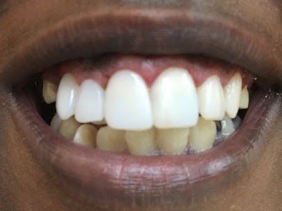tooth decay