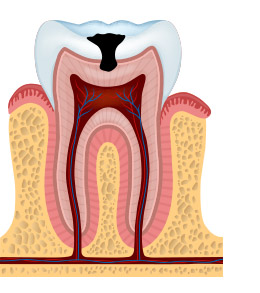 tooth decay