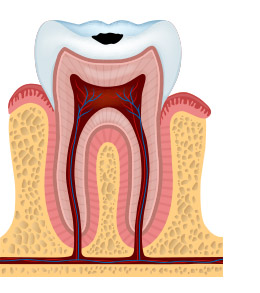 tooth decay