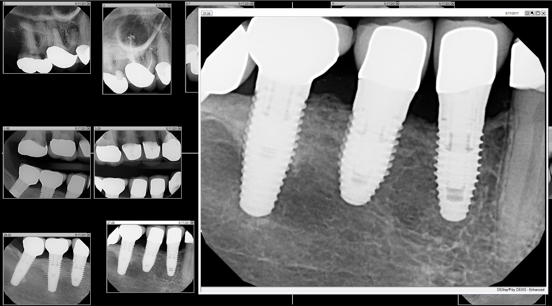 Functioning Implants