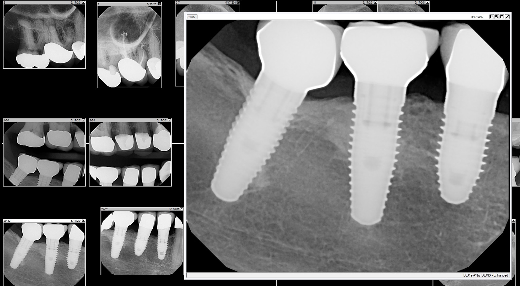 Functioning Implants