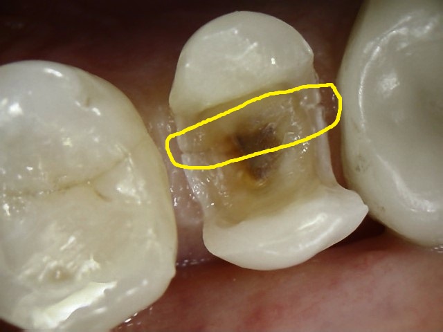 Cracked Tooth Syndrome