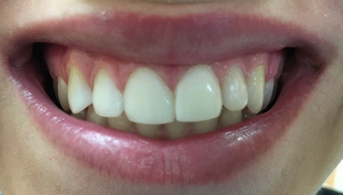 3 Teeth Veneered