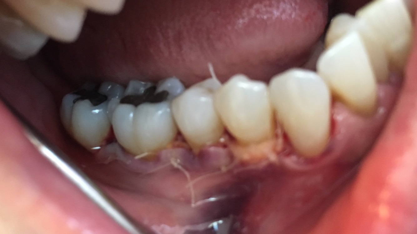 After Graft Surgery
