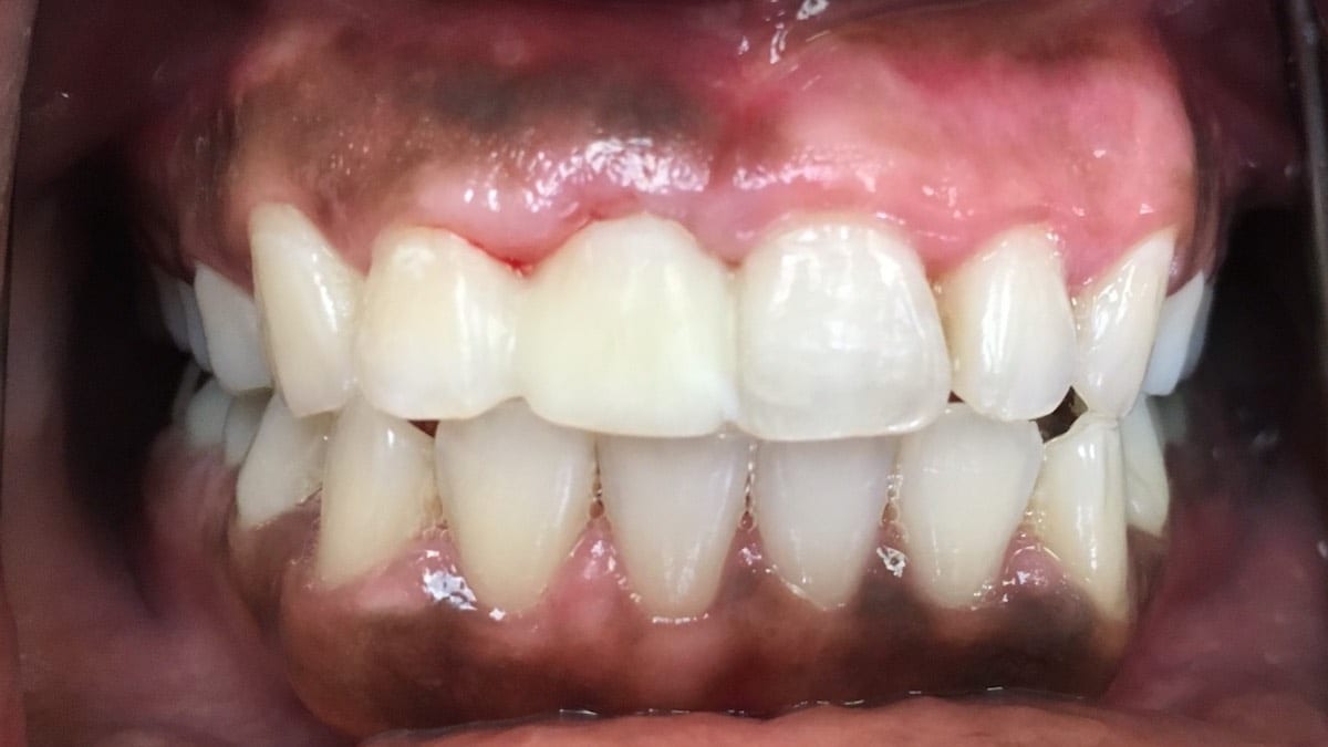 Severe Infection