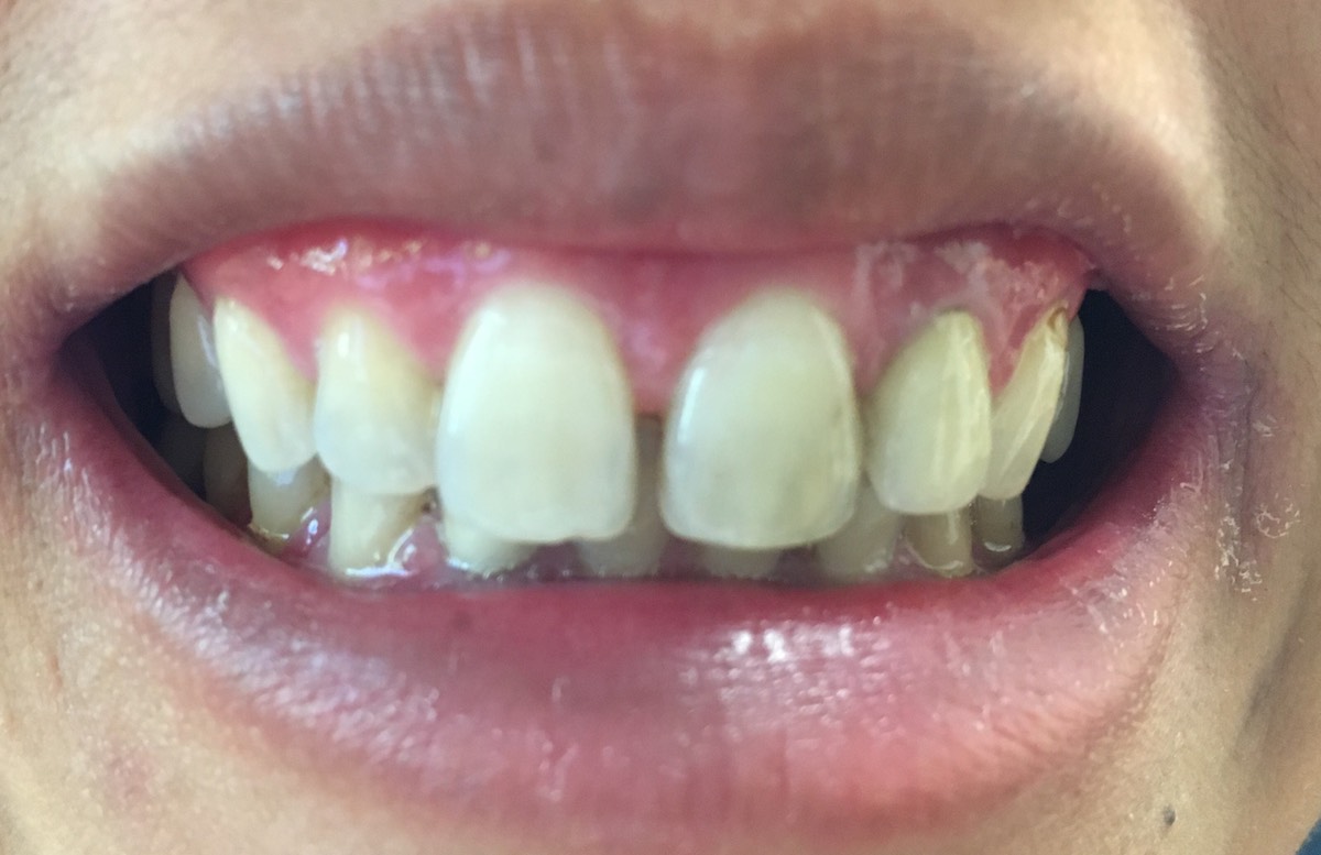 5 Teeth Veneered